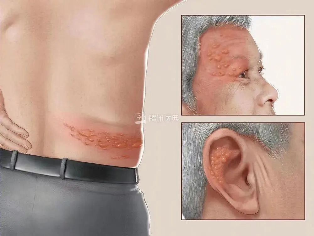 帶狀皰疹（蛇纏腰），會(huì)傳染嗎？
