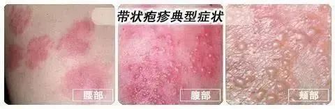 帶狀皰疹（蛇纏腰），會(huì)傳染嗎？