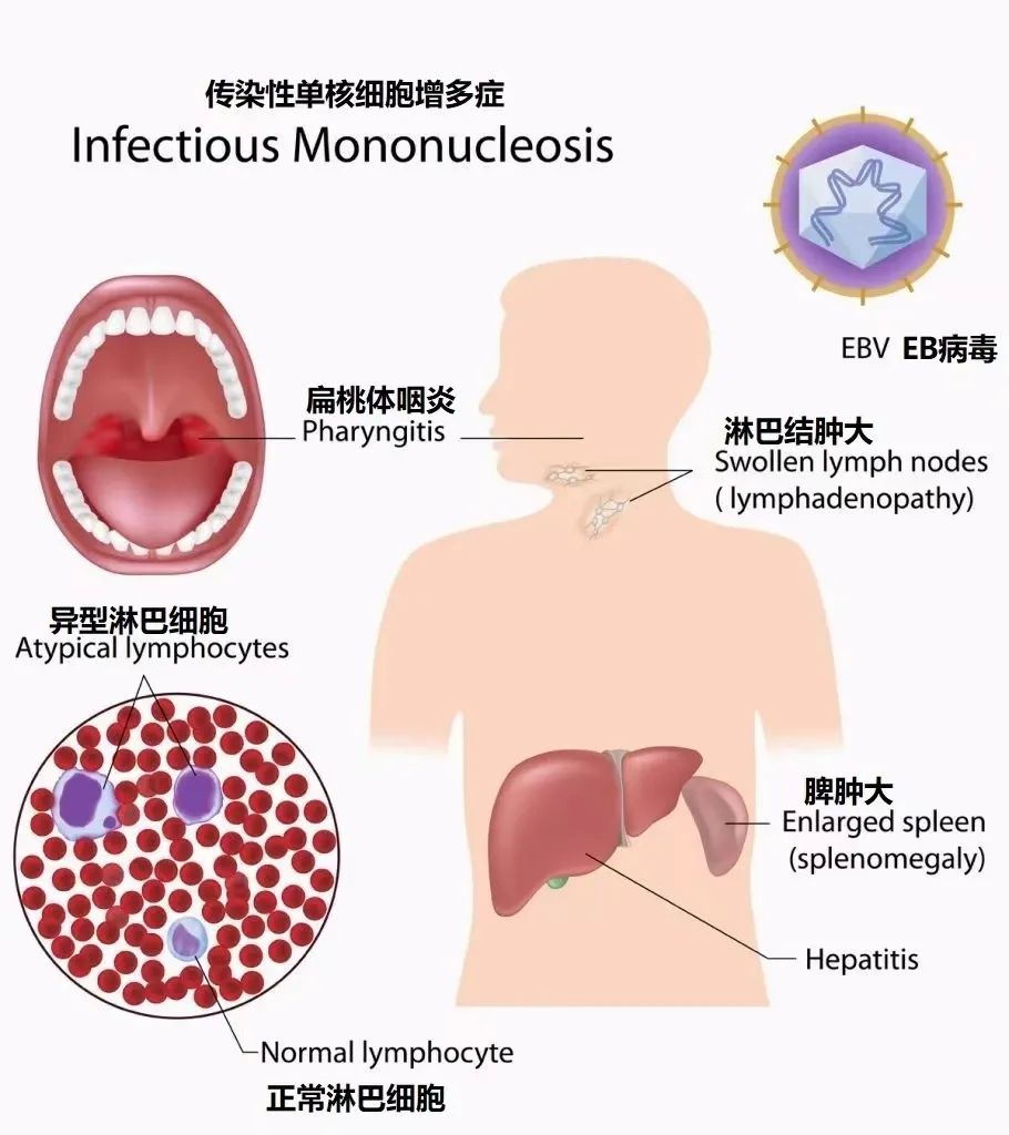 傳染性極強，這個病毒一旦感染“終身攜帶”，看似感冒卻更兇險